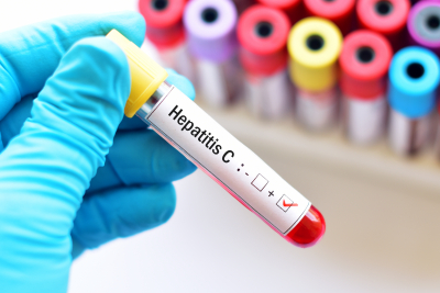 blood sample with hepatitis C